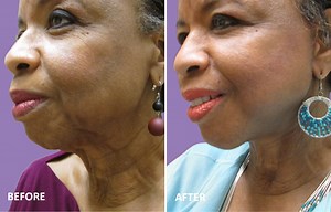 Before/After Pictures - Juvilee Facial Rejuvenation