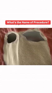 What’s the Name of this Procedure? | Medical Talks