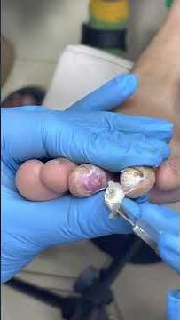 Plantar Warts Grow On Children's Feet #pedicure