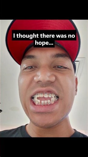 1 Year With Braces: My Open Bite Progress! #openbite