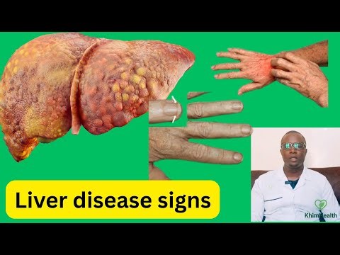 How Your Hands Are Exposing Liver Damage — Warning Signs You Must Not Ignore