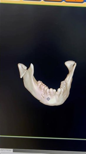 This Is How a Mandible Fractures in 3D 😱 #shorts