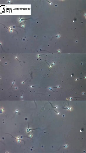 Semen Analysis: One Slide, Full Story #Reels #fyp #medicallabscientist #fblifestyle #foryou #mls #SemenAnalysis #SemenSmear #SpermMorphology #MaleInfertility #LabDiagnosis #MedicalLab #ClinicalLab #HealthcareInfo #Pathology #semen #MedEducation #Microscopy #ScienceFacts #Diagnostics #MedTech #LabProfession #MedicalFacts #HealthTips #LabTest #DidYouKnow #MensHealth | Medical Laboratory Scientist - MLS