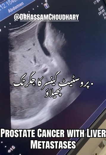 Prostate Cancer with Liver Metastases | Ultrasound Appearance Prostate cancer most commonly metastasizes to the bones, but in advanced stages, tumor cells may spread through the bloodstream and involve visceral organs, including the liver. Hepatic metastasis is generally associated with a more aggressive disease course and poorer prognosis, making early recognition on imaging crucial. On ultrasound, liver metastases from prostate cancer can present with a variety of appearances, depending on tum