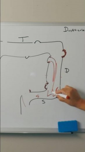 What is a diverticular bleed 🩸?