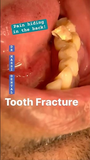 Cracked molar: Pain hiding in the back!
