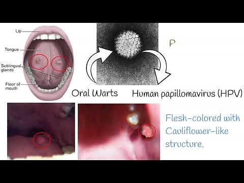 Oral Papilloma - Symptoms, causes, treatment