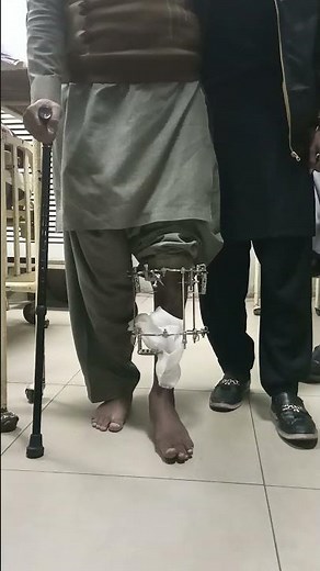 Ilizarov Frame – Early Mobilization on Post-Op Day 1