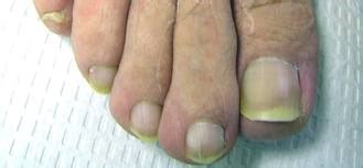 does white vinegar kill toenail fungus