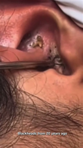 Blackheads from 20 years ago
