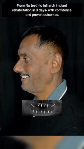 Smile Makeover with Dental Implant