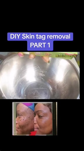 Effective DIY Skin Tag Removal Method