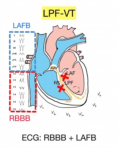 Fascicular VT (Part 1): Basic ECG Findings 📉 • Left Posterior Fascicular VT: ECG pattern shows RBBB (right bundle branch block) and LAFB (left anterior fascicular block). • Left Anterior Fascicular VT: ECG pattern shows RBBB (right bundle branch block) and LPFB (left posterior fascicular block). #Cardiology #FascicularVT #ECGFindings #Cardiologists #HeartHealth 🫀📊 | Abdallah Othman