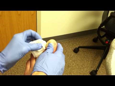 Pus Squeezed From Infected Toe