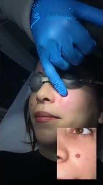 Removal of verrucous nevus with Smartxide Punto CO2 laser. Only one session is needed. No scarring.