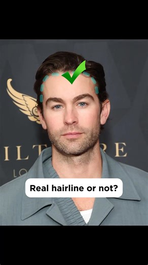 Can you spot their natural hairlines? 🧐 #haircodeai #haircode #hairline #recedinghairline #hairloss #minoxidil | Hair IQ