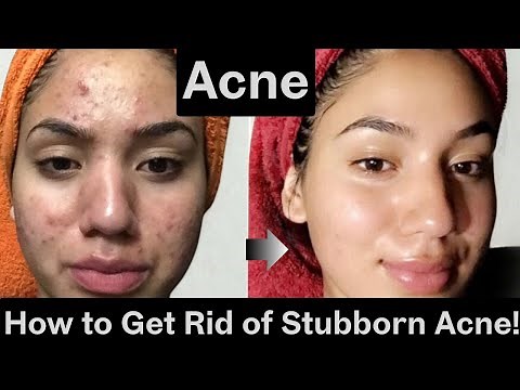 How to Get Rid of Acne at ANY Age | Dermatologist-Approved Skincare Guide