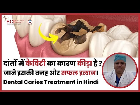 Dental Caries क्या होता है? | Tooth Cavity Stages in Hindi | Dr. Amit Parashar | SCI Hospital
