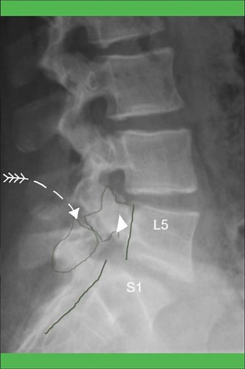 L5 pars interarticularis fracture with spondylolisthesis
