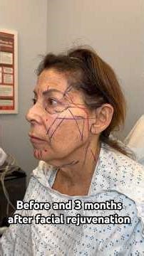 Facelift Journey: Before and 3 months after facial rejuvenation
