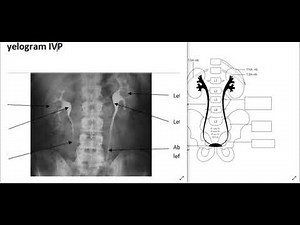 Renal x-ray (IVP)
