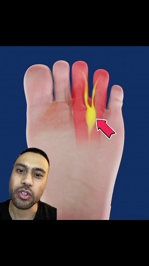 Morton’s neuroma #neuroma #disease #podiatrist #podiatry #podiatrylife #feet #feetcare #feetfirst #footpainrelief #painrelief #medicine #doctors #doctor #neurology #neurologist #nervepain #nervedamage #nerves #Neuropathy | The Good Foot Doctor