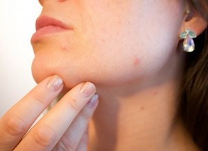 7 Signs That Acne is Healing | Mulberry House Clinic
