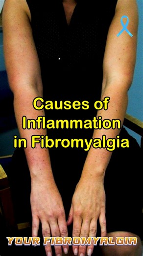 Causes of Inflammation in Fibromyalgia The exact cause of fibromyalgia is unknown, but it is linked to inflammation, particularly neuroinflammation, triggered by a combination of genetic predisposition, central sensitization, and external factors like stress, infections, and physical trauma. These triggers can activate the body's immune system and stress response, leading to the development or worsening of the condition through mechanisms like the gut-brain axis and an altered inflammatory respo