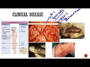 Herpes Simplex Virus