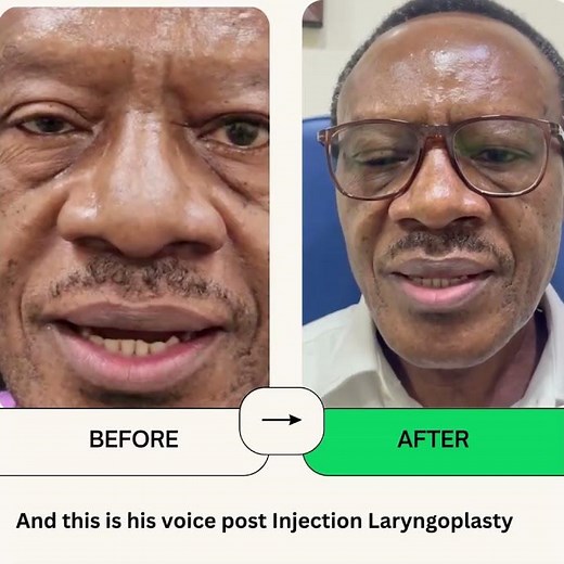 Injection Laryngoplasty for vocal cord paralysis