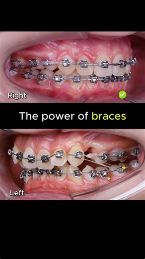 The power of braces. Fix crooked teeth #braces #orthodontist #dentist