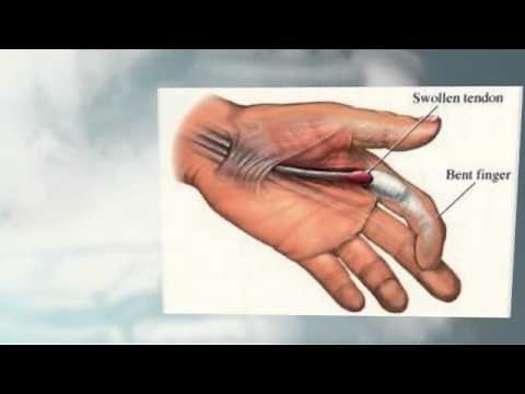 Index Finger Pain - Understanding Hand Pain