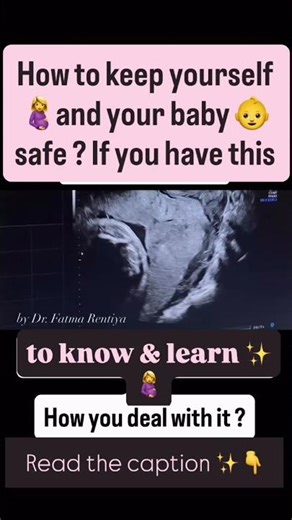 गर्भावस्था में प्लेसेंटा प्रेविया हो सकता हैं जानलेवा- कैसे सुरक्षित रहें? 👇नीचे डिस्क्रिप्शन पढ़ें