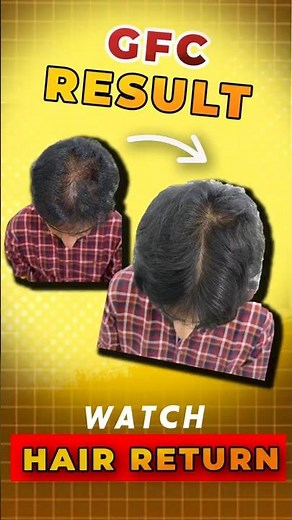 GFC Hair Growth REAL Results! 😱 Before/After WOW 🤯