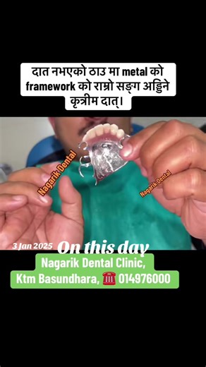 Understanding Partial Dentures: Benefits and Care Tips