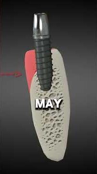 Dental Bone Grafting Procedure