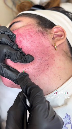 Électrolyse : La Solution Pour Une Peau Douce Et Sans Poils