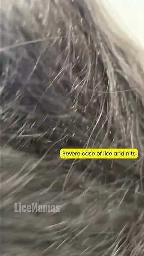 Severe case of lice and nits #licetok #licetreatment