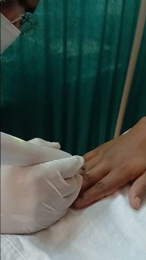 Verruca Vulgaris Removal #Medicine #Dermatology #Warts #Cautery #Papiloma #Skin #Remedies #Cosmetic