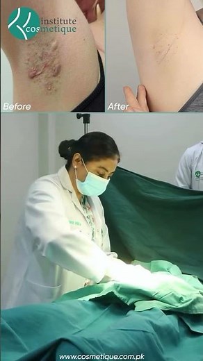 Hidradenitis Suppurativa Explained | Advanced HS Treatment by Dermatology Experts | Cosmetique