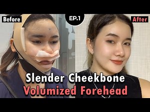 [SUB] Quick Cheekbone Reduction & Facial Fat Grafting Surgery in Korea | Reduction Malarplasty Vlog