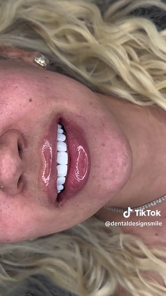 Composite Resin in Dentistry: Aesthetic Restorations