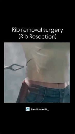 Asthetic1447 on Instagram: "Rib removal surgery, or rib resection, is the surgical removal of a portion of a rib to treat medical conditions like thoracic outlet syndrome (TOS) or to improve surgical exposure in chest procedures. A first rib resection specifically targets the rib beneath the collarbone to relieve nerve or blood vessel compression, often through a transaxillary (underarm) or supraclavicular (above the collarbone) incision. Recovery involves managing pain, restricted activity for 