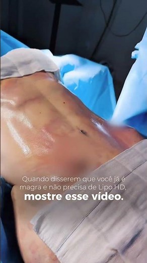 HD LIPOSUCTION ON A THIN WOMAN: Look at this unbelievable before and after! 😱✨
