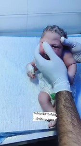 This precious baby was born with microcephaly, a rare condition where a baby’s head is smaller than expected due to early brain development issues. 💕 Under the loving care of NICU doctors and nurses, this little fighter is showing incredible strength and resilience. 🌈 Let’s spread love, understanding, and prayers for all babies facing health challenges. Every life is beautiful, every heartbeat is a miracle. 🙏👶 #NICUUpdates #Microcephaly #MicrocephalicBaby #NICUBaby #BraveBaby #TinyFighter #M