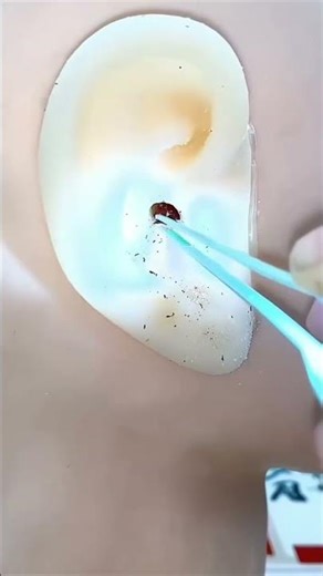 Ear Cleaner Tool Endoscope Otoscope, Ear Wax Cleaner with 1080p FHD Camera Ear wax remover Tool