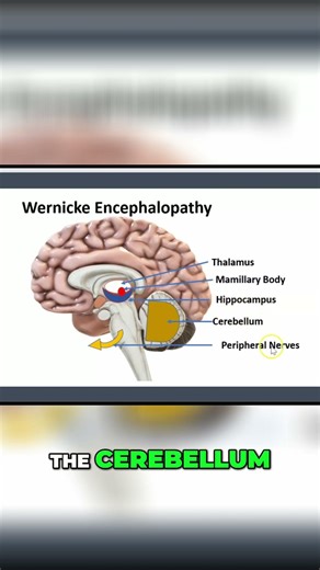 Wernicke Encephalopathy: Symptoms, Causes, and Affected Areas #shorts