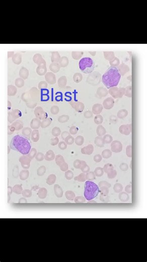 ✨ Interpreting the Relationship Between Scattergrams and Blood Smears ✨ 🍁 The use of automated hematology analyzers to evaluate cell distribution through scattergrams significantly enhances the accuracy of cell classification and data interpretation. 🍁 The system utilizes Forward Scatter (FSC) and Side Scatter (SSC) parameters to display the position of cells on a graphical plot, reflecting differences in cell size and internal complexity. 🍁This type of visualization allows for easier recogni