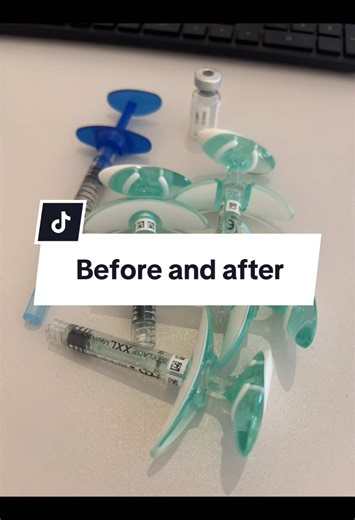 ✨Un double menton , c’était la problématique de cette patiente. J’ai choisis l’acide hyaluronique pour donner un aspect affiné et amincissant à son visage ✨ #jawline #beforeandafter #avantapres #injections #esthetique