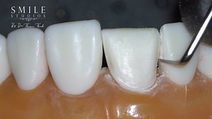 Dental Veneer Type I prep @ BAIRD training program next week in #Baghdad | British Academy of Implant and Restorative Dentistry